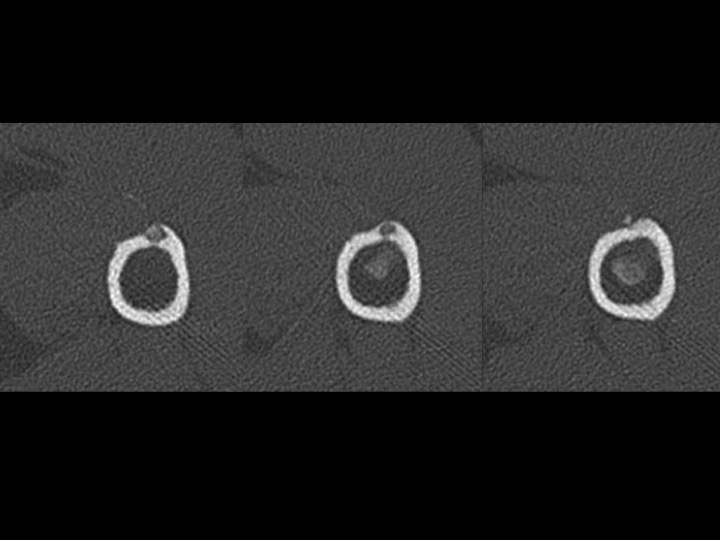 Figure 2 for case tendon of pectoralis major ( RID2007 )